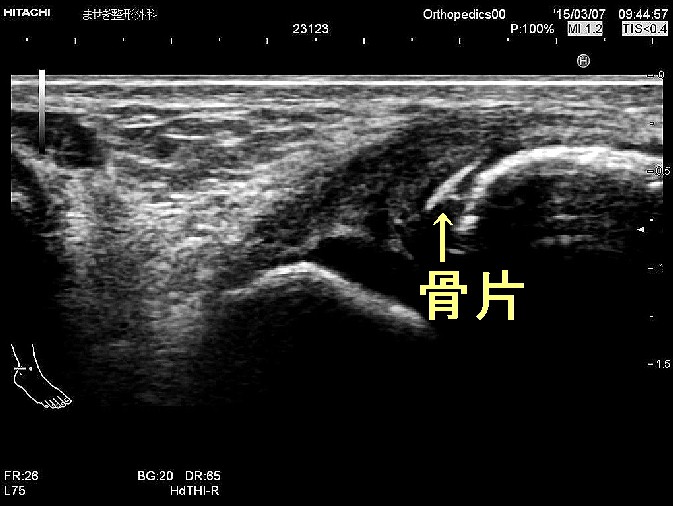 [変更小児ATFL1