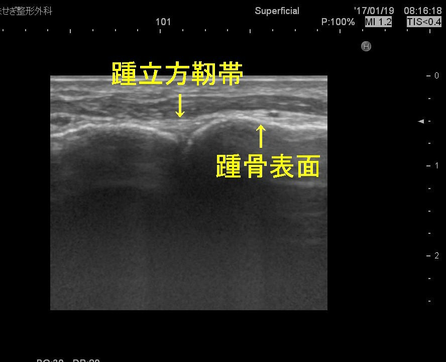 踵骨前方　変更２