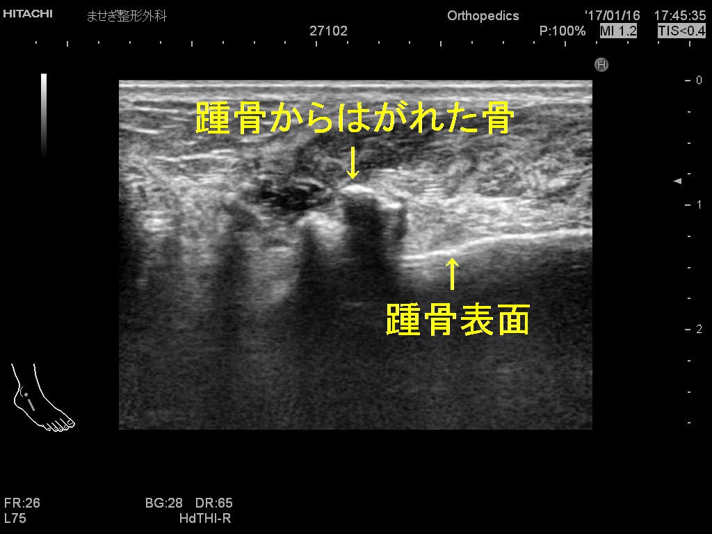 踵骨前方　変更１