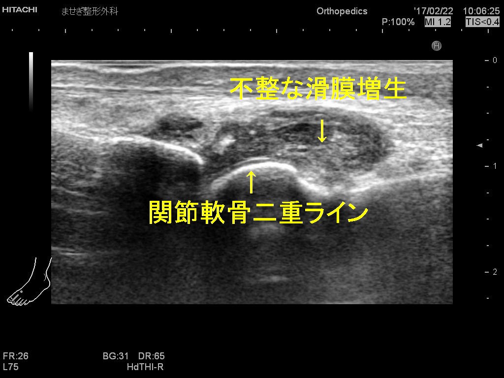 痛風第一変更