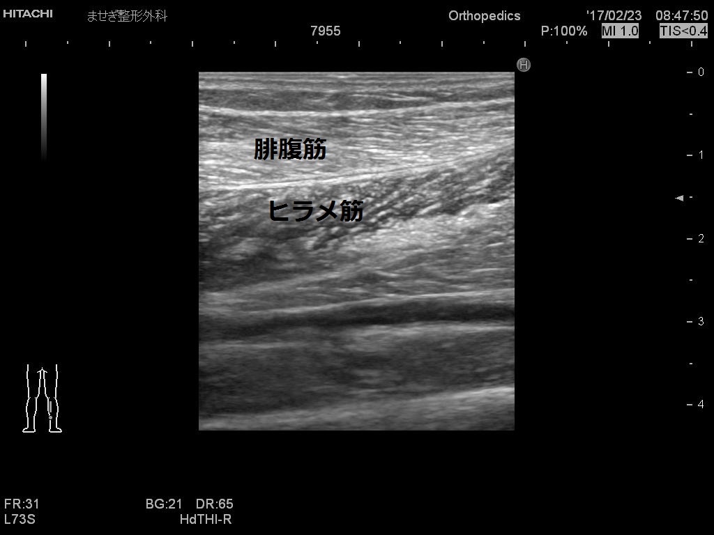 腓腹筋、ヒラメ筋２変更