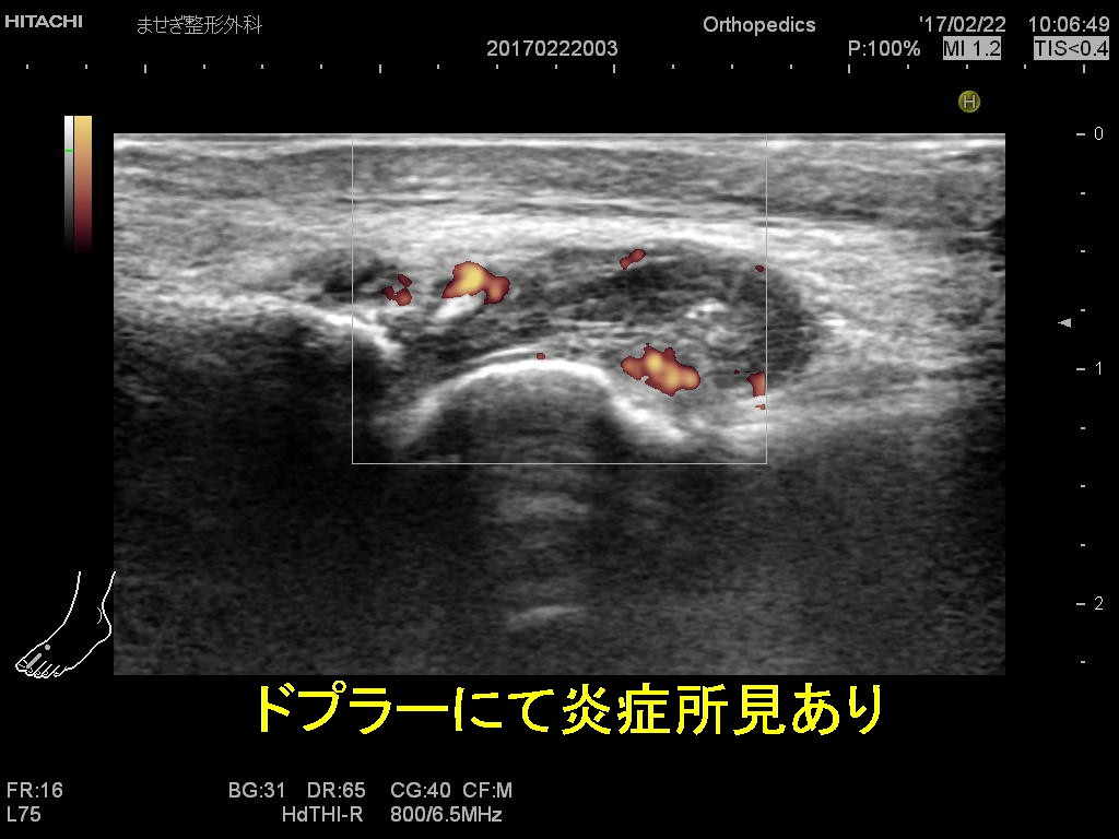 痛風第1変更２