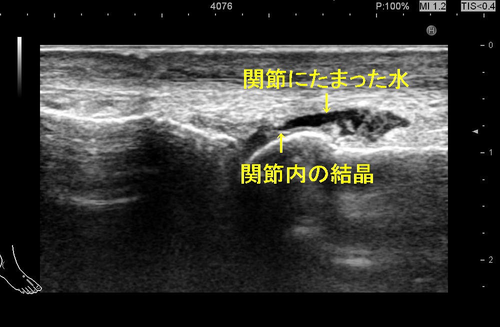 痛風１