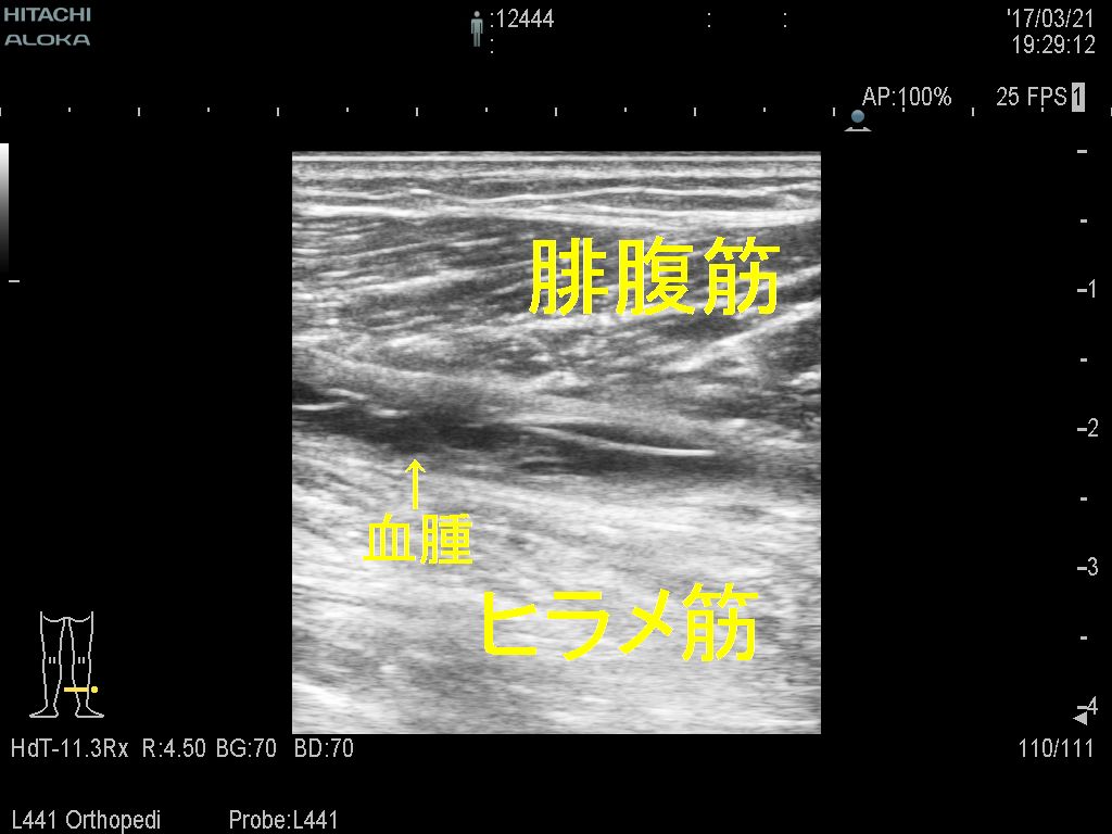 肉離れ3週間