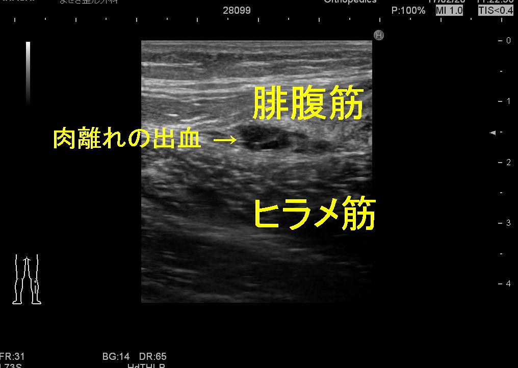 肉離れとエコー 愛知県岡崎市 整形外科 リウマチ科 エコーガイド下筋膜リリース ませぎ整形外科