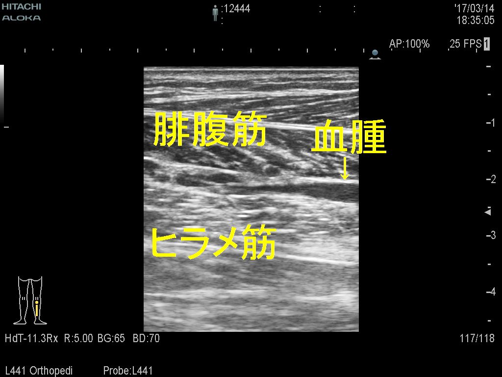 肉離れ出血変更