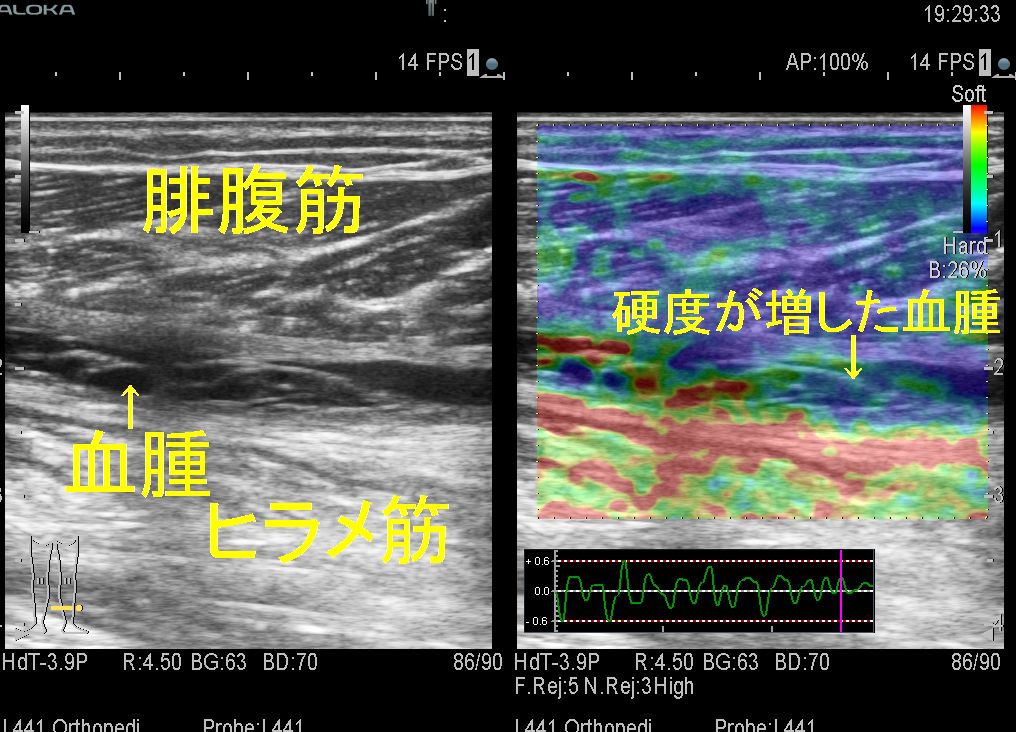 肉離れ３週間エラスト