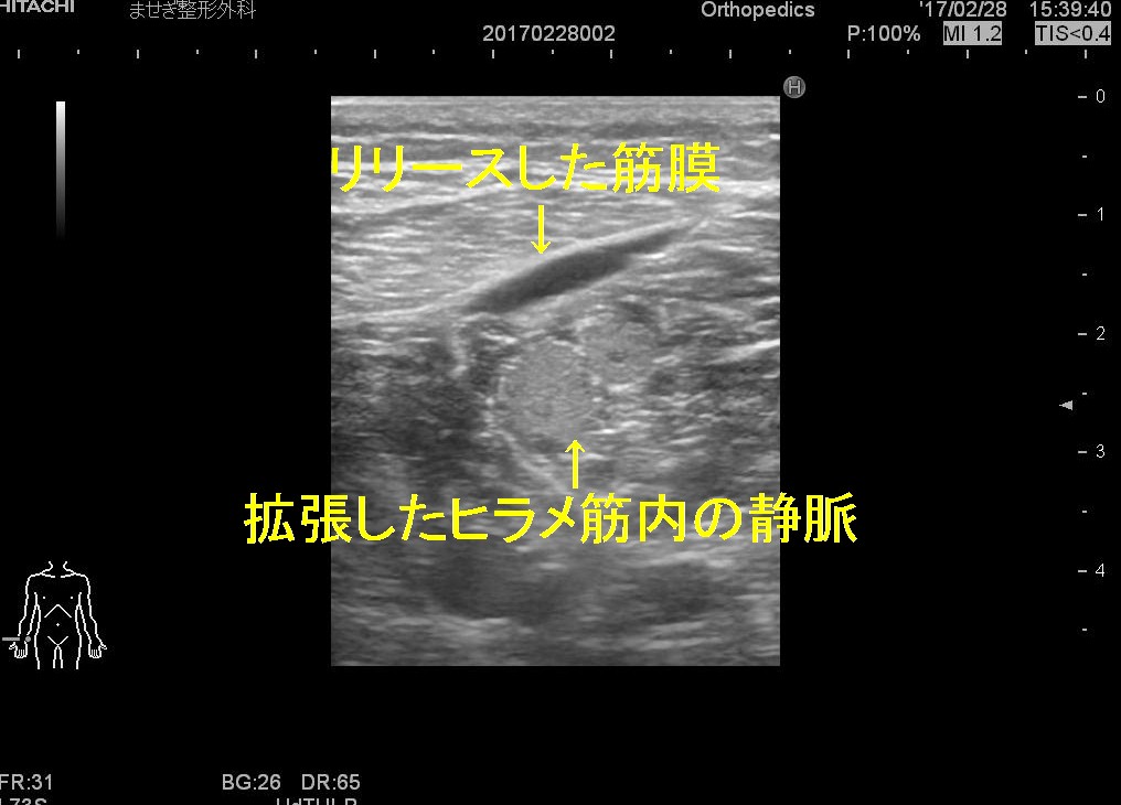 深部静脈血栓症ともやもやエコー 愛知県岡崎市 整形外科 リウマチ科 エコーガイド下筋膜リリース ませぎ整形外科