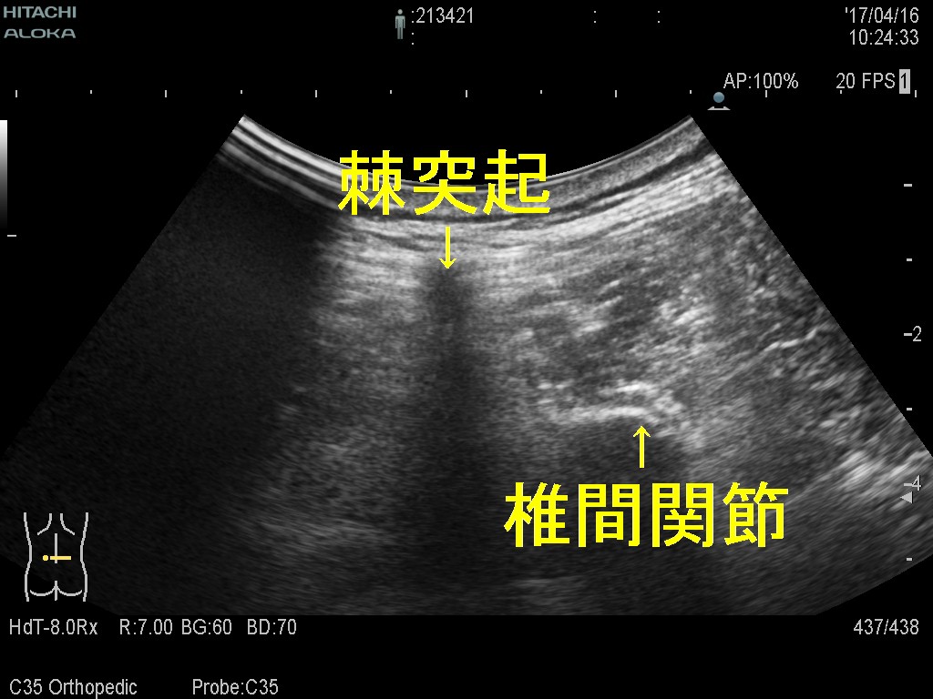 脊椎横断２