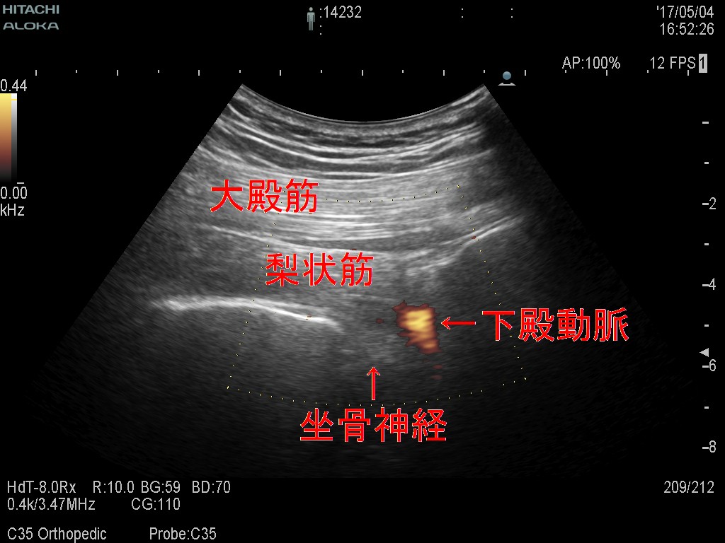 梨状筋エコー画像
