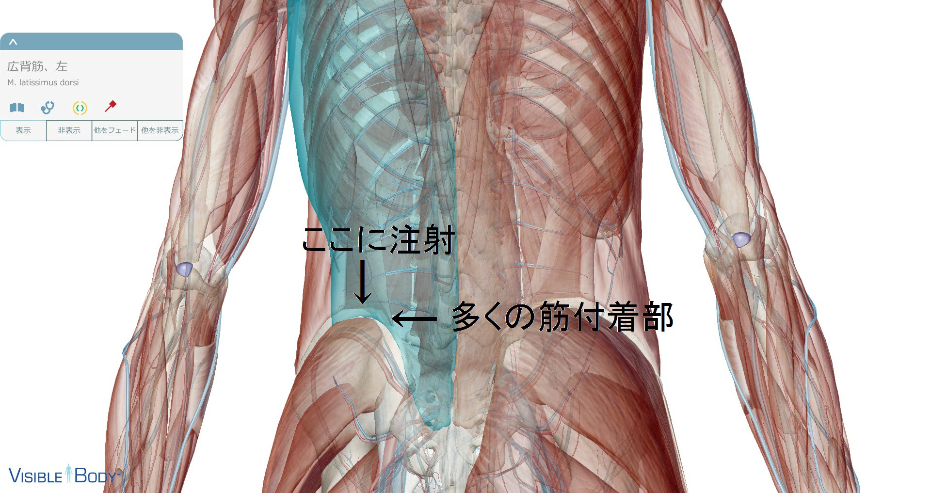 腸骨筋肉注射