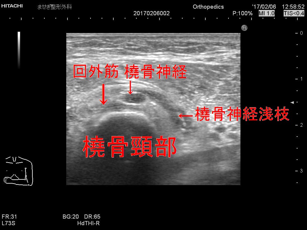 橈骨神経腫大変更