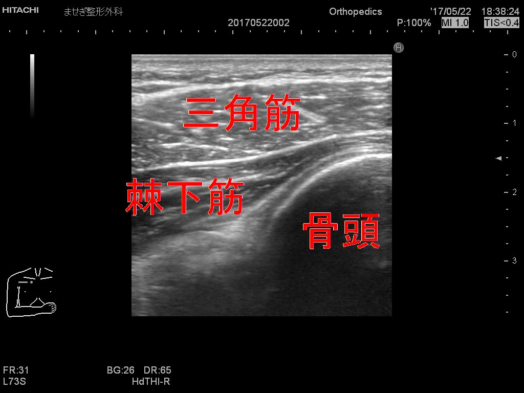 [20170522]棘下筋１２