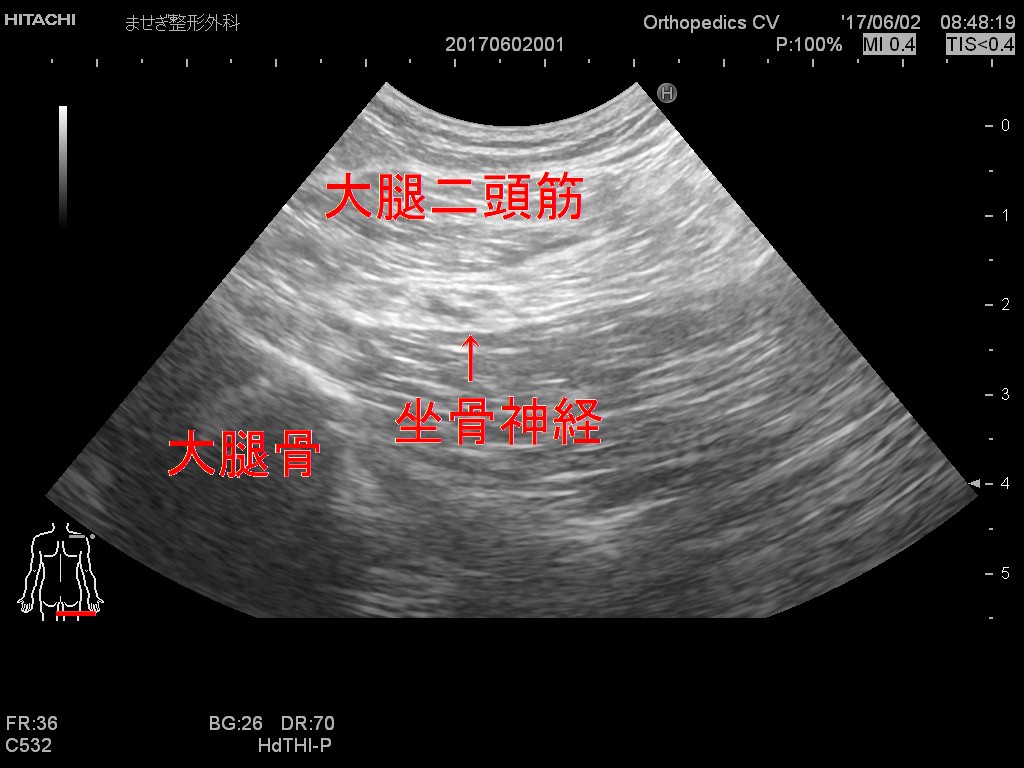 大腿部坐骨神経