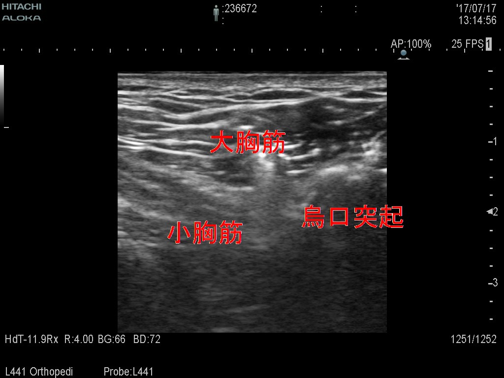 小胸筋変更