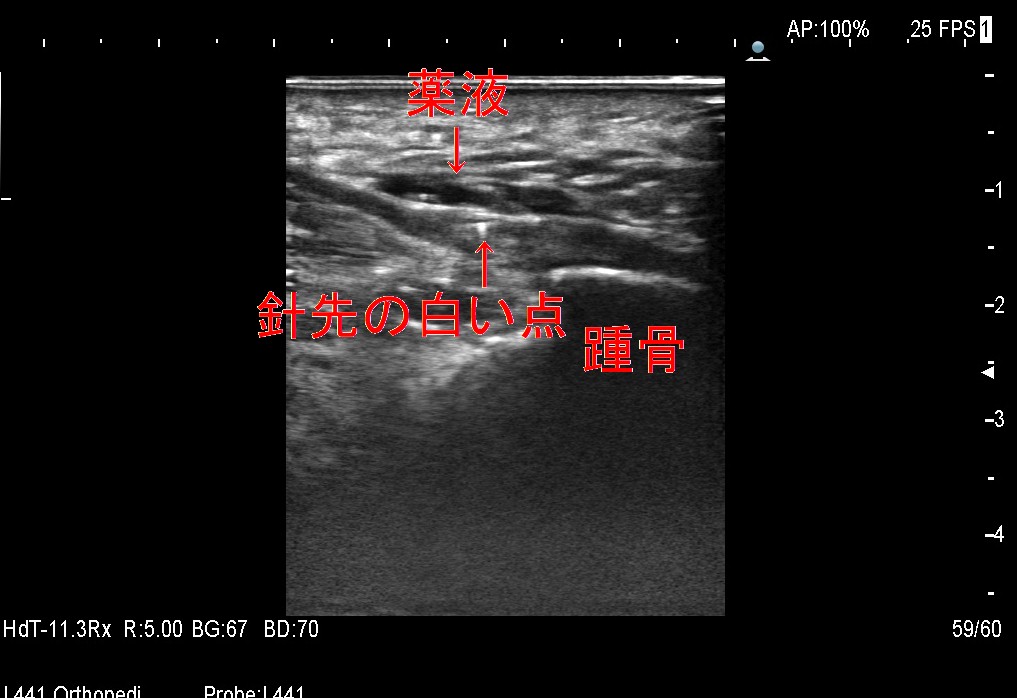 足底腱膜注射