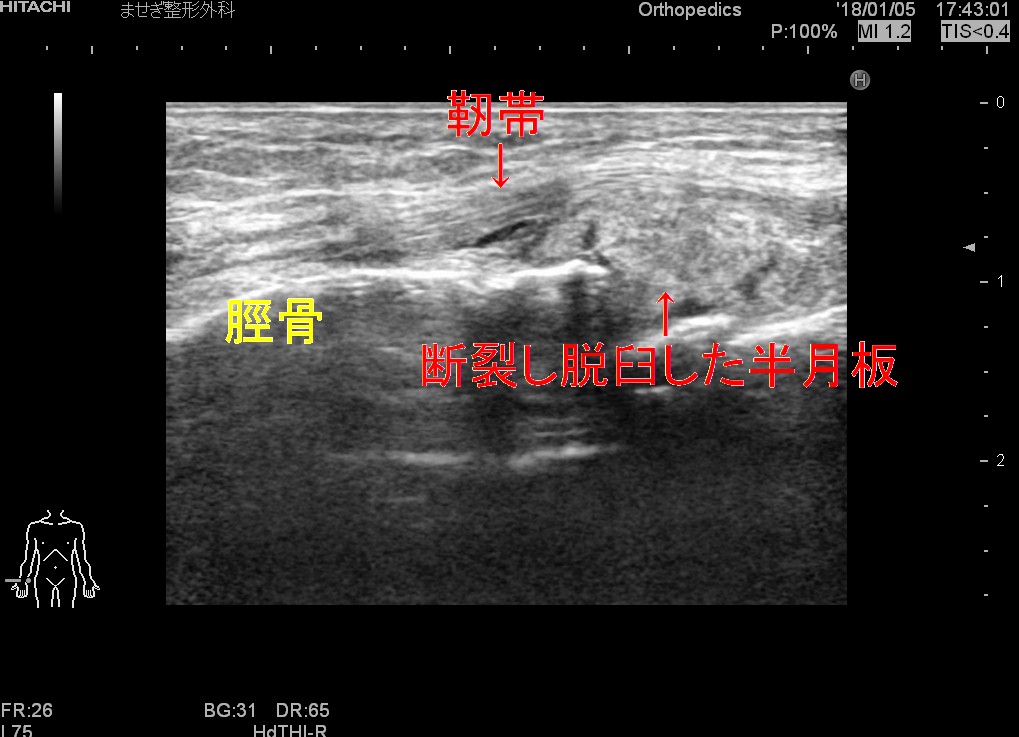 半月板の痛み 愛知県岡崎市 整形外科 リウマチ科 エコーガイド下筋膜リリース ませぎ整形外科