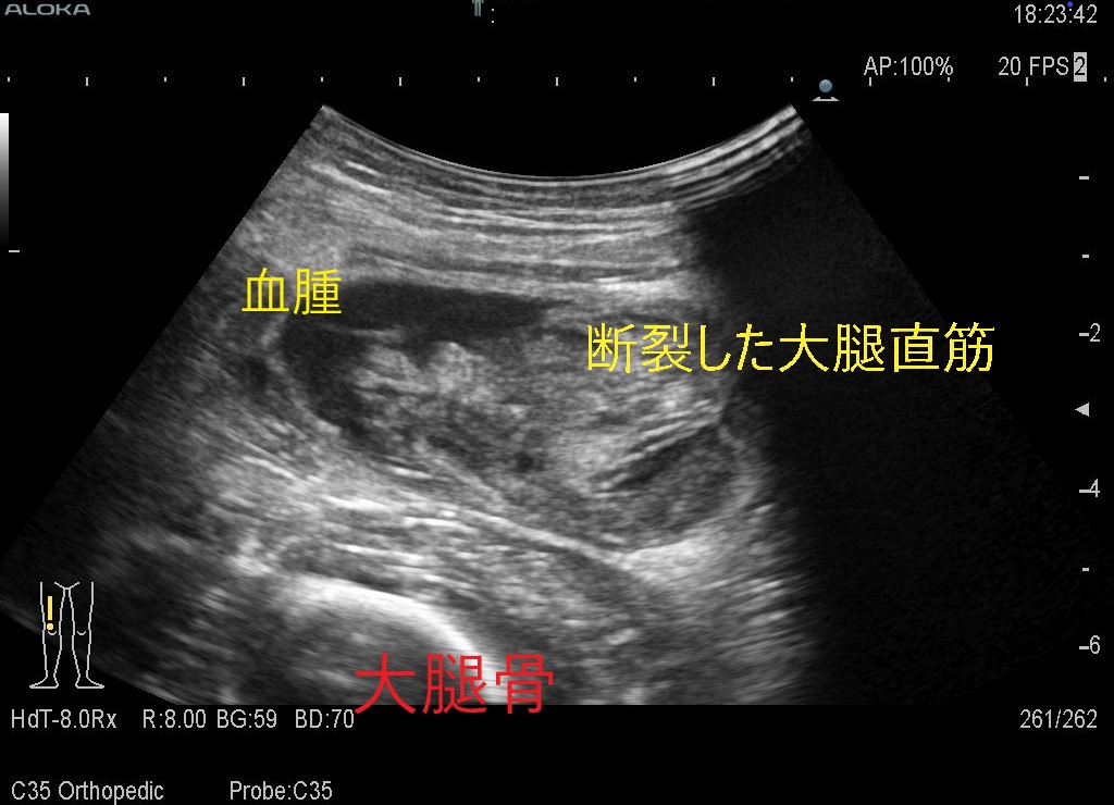 大腿直筋断裂1