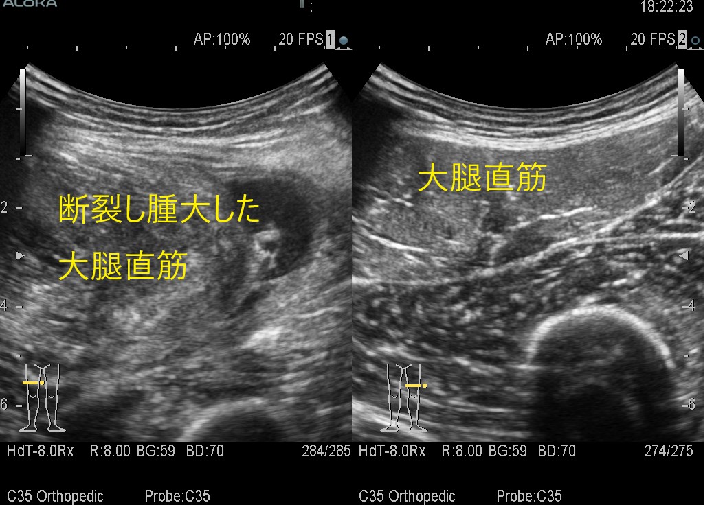 大腿直筋２