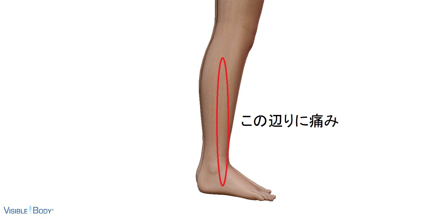 下腿外側の痛み 愛知県岡崎市 整形外科 リウマチ科 エコーガイド下筋膜リリース ませぎ整形外科