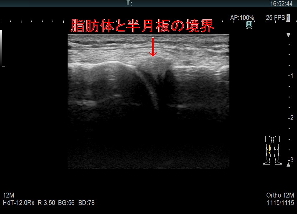 膝のロッキング 愛知県岡崎市 整形外科 リウマチ科 エコーガイド下筋膜リリース ませぎ整形外科