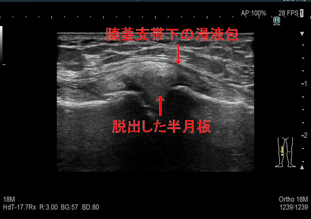 膝のロッキング 愛知県岡崎市 整形外科 リウマチ科 エコーガイド下筋膜リリース ませぎ整形外科