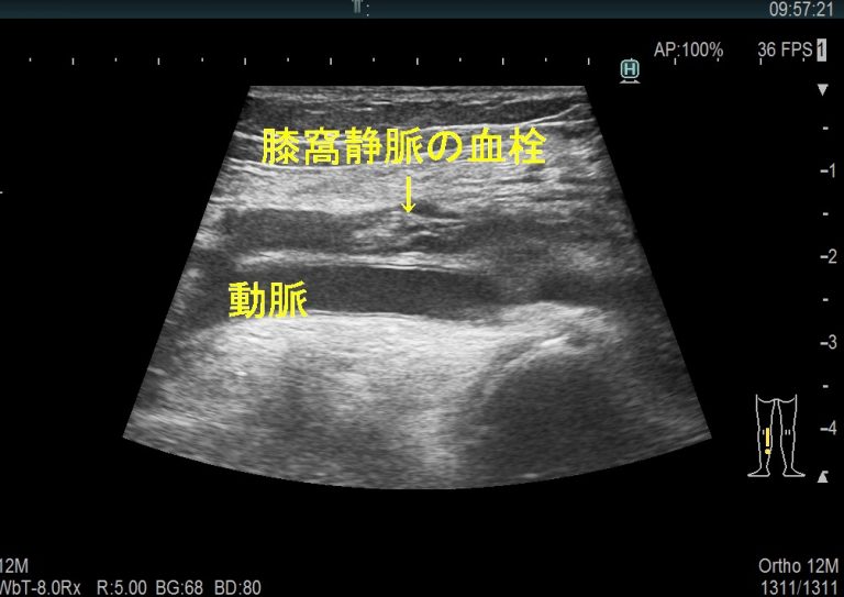 血栓静脈炎の症状は何ですか?